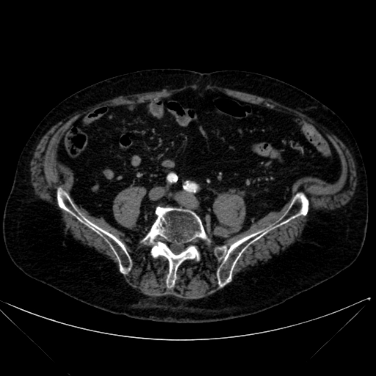Abdominal aortic aneurysm (Radiopaedia 25855-26001 Axial C+ arterial phase 93).jpg