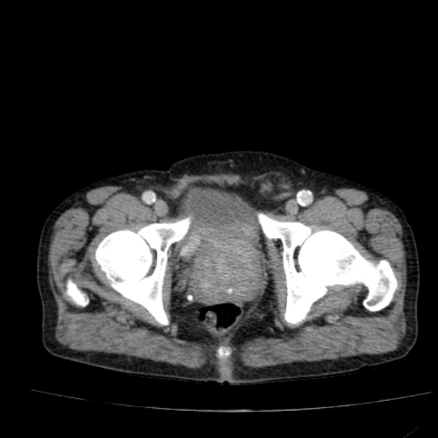 Abdominal aortic aneurysm (Radiopaedia 29248-29660 Axial C+ portal venous phase 60).jpg