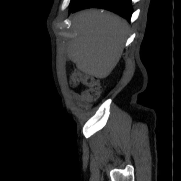 Abdominal aortic aneurysm (Radiopaedia 29248-29660 Sagittal C+ arterial phase 4).jpg