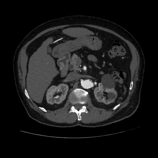 File:Abdominal aortic aneurysm (Radiopaedia 57318-64259 Axial C+ arterial phase 25).jpg