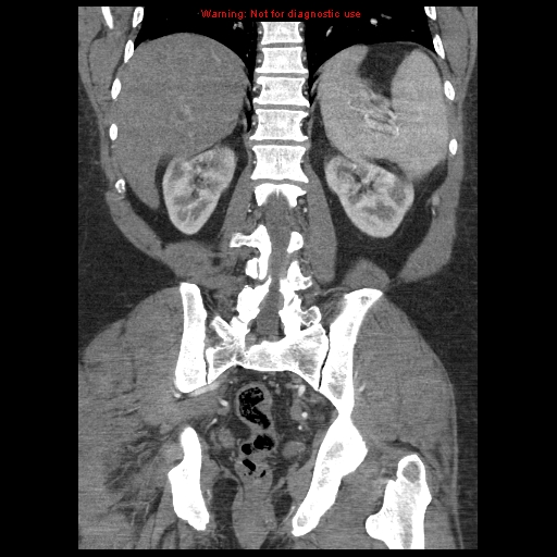 Abdominal aortic aneurysm (Radiopaedia 8190-9038 Coronal C+ arterial phase 93).jpg