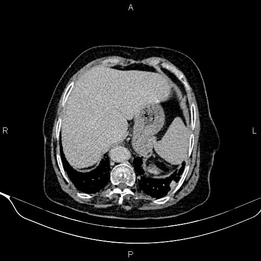 Abdominal aortic aneurysm (Radiopaedia 85063-100606 Axial C+ delayed 2).jpg