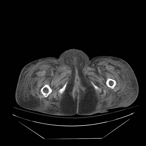Abdominal aortic aneurysm - impending rupture (Radiopaedia 19233-19247 Axial non-contrast 181).jpg