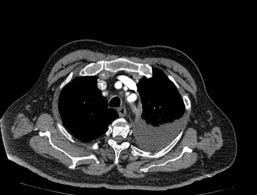 Abdominal aortic aneurysm rupture (Radiopaedia 54179-60362 Axial C+ arterial phase 3).jpg