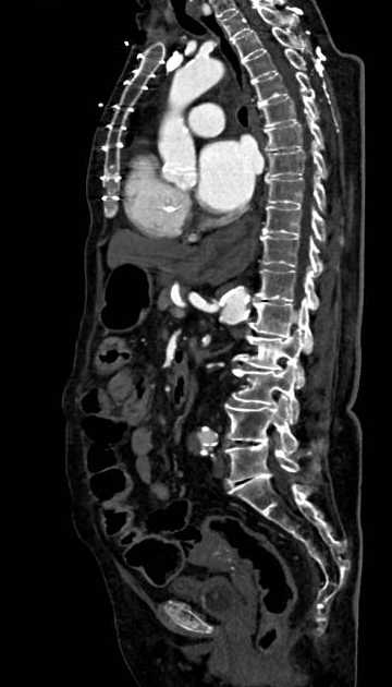 Abdominal aortic aneurysm with thrombus fissuration (Radiopaedia 73192-83919 Sagittal C+ arterial phase 63).jpg