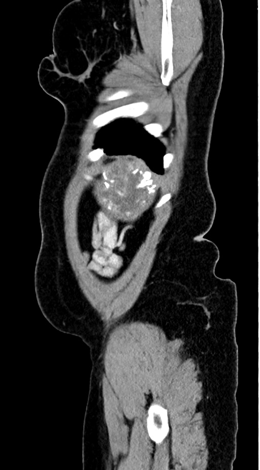 Abdominal hydatid disease (Radiopaedia 68223-77737 Sagittal C+ portal venous phase 4).jpg