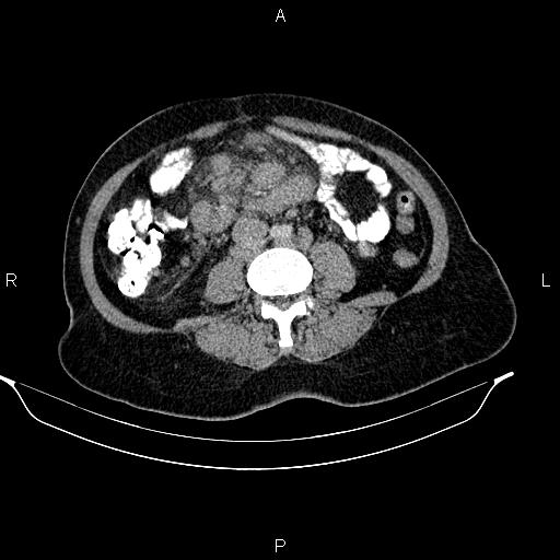 Abdominal lymphoma with sandwich sign (Radiopaedia 84378-99704 Axial C+ portal venous phase 35).jpg