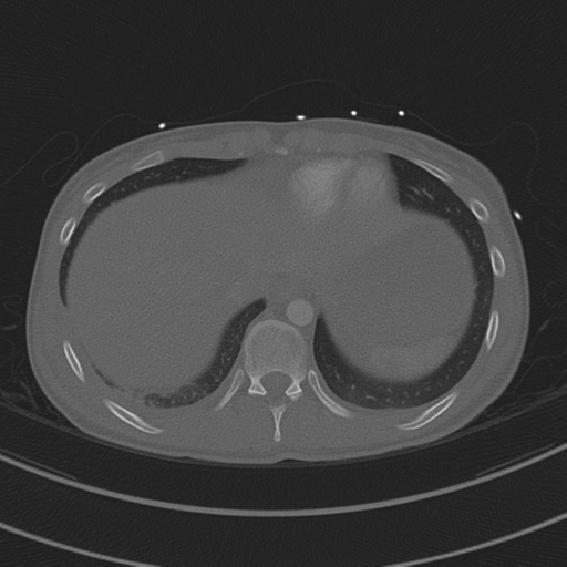 File:Abdominal multi-trauma - devascularised kidney and liver, spleen and pancreatic lacerations (Radiopaedia 34984-36486 I 70).png