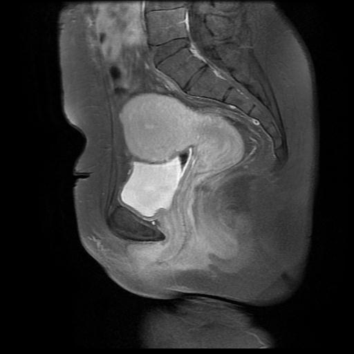 File:Abdominal wall endometriosis (Radiopaedia 83702-98847 Sagittal T1 C+ fat sat 9).jpg