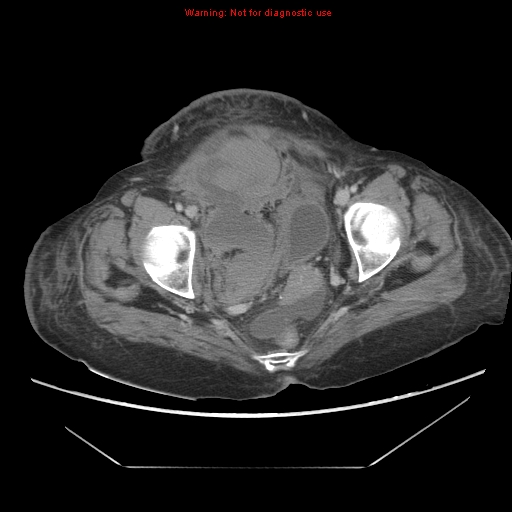File:Abdominal wall hematoma (Radiopaedia 9427-10112 Axial C+ portal venous phase 98).jpg