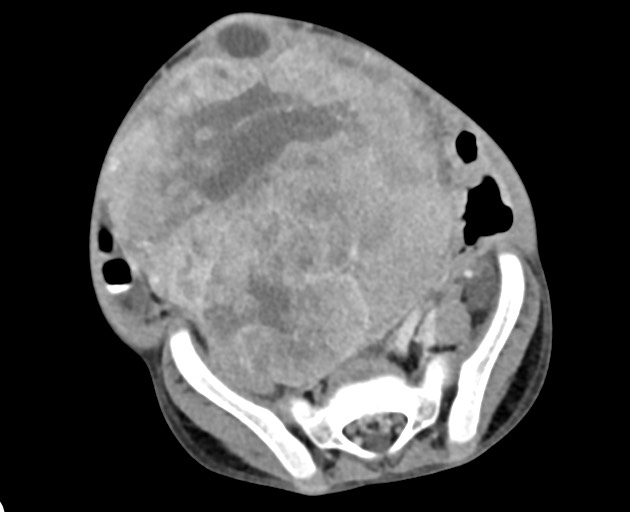 Abdominopelvic rhabdomyosarcoma (Radiopaedia 78356-90984 Axial C+ portal venous phase 123).jpg