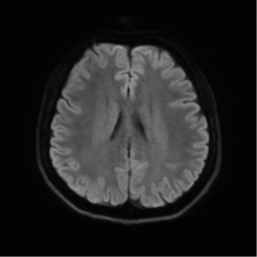 Abducens nerve palsy (Radiopaedia 51069-56648 Axial DWI 44).png