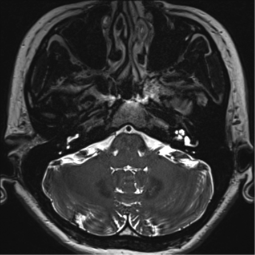 File:Abducens nerve palsy (Radiopaedia 51069-56648 Axial T2 fat sat 14).png