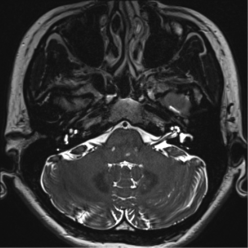 Abducens nerve palsy (Radiopaedia 51069-56648 Axial T2 fat sat 16).png