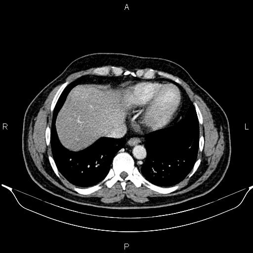 File:Aberrant right subclavian artery (Radiopaedia 87093-103354 Axial With contrast 85).jpg
