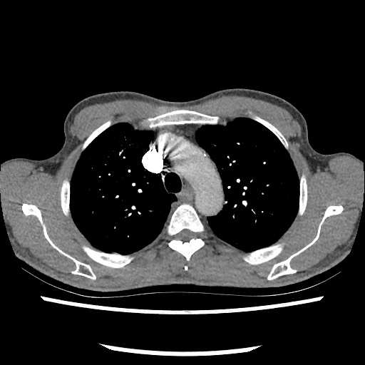 Accessory left horizontal fissure with lingular pneumonia (Radiopaedia 53763-59843 Axial C+ CTPA 28).jpg