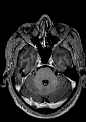 Accessory middle cerebral artery (Radiopaedia 73114-83828 Axial T1 C+ 113).jpg