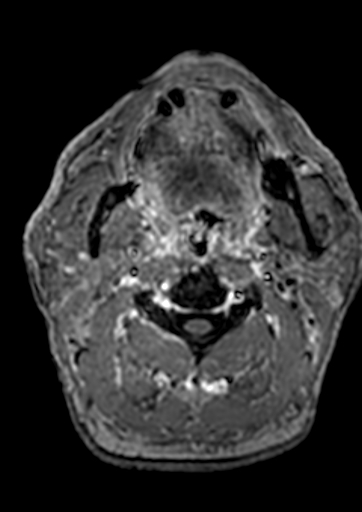 Accessory middle cerebral artery (Radiopaedia 73114-83828 Axial T1 C+ 263).jpg