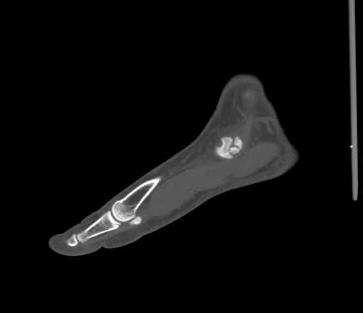 File:Accessory navicular bone (Radiopaedia 54999-61314 Sagittal non-contrast 21).jpg