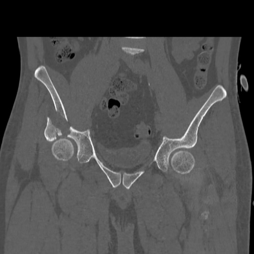 Acetabular and ilial fractures (Radiopaedia 59084-66378 Coronal bone window 20).jpg