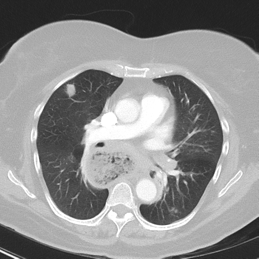 File:Achalasia (Radiopaedia 47147-51685 Axial lung window 24).png