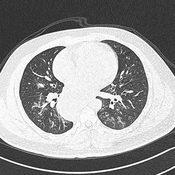 Achalasia with aspiration (Radiopaedia 55413-61845 Axial lung window 42).jpg