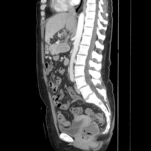 Acinar cell carcinoma of the pancreas (Radiopaedia 75442-86669 Sagittal C+ portal venous phase 98).jpg