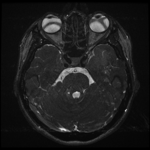 Acoustic neuroma (Radiopaedia 34049-35283 Axial 75).png
