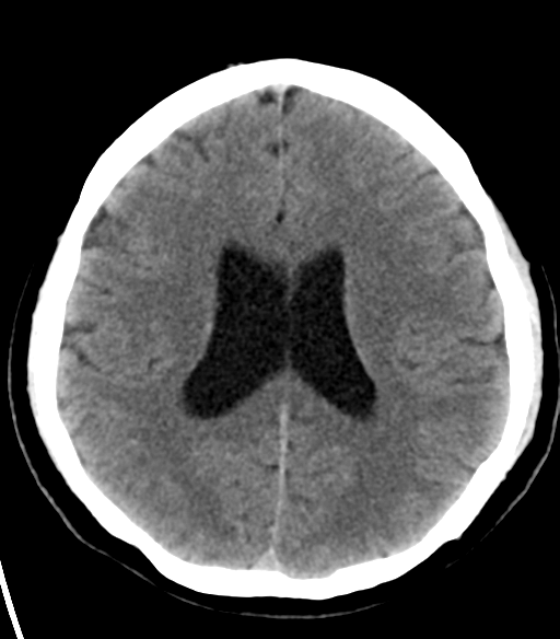 File:Acoustic schwannoma (Radiopaedia 33045-34065 Axial non-contrast 17).png