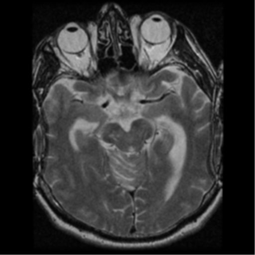 File:Acoustic schwannoma (Radiopaedia 39170-41387 Axial T2 15).png