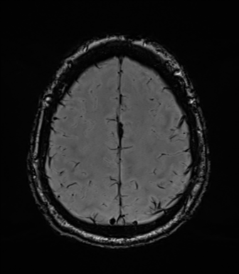 Acoustic schwannoma (Radiopaedia 50846-56358 Axial SWI 75).png