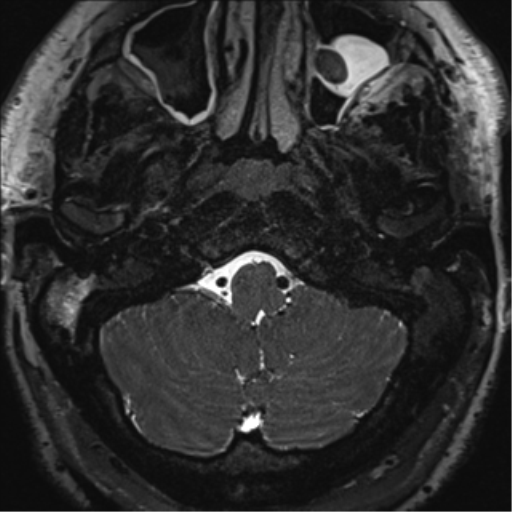 File:Acoustic schwannoma (Radiopaedia 50846-56358 Axial T2 2).png