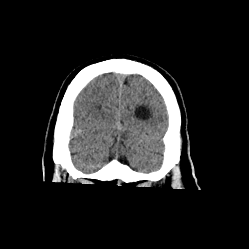 File:Acoustic schwannoma (Radiopaedia 55729-62280 Coronal non-contrast 35).png