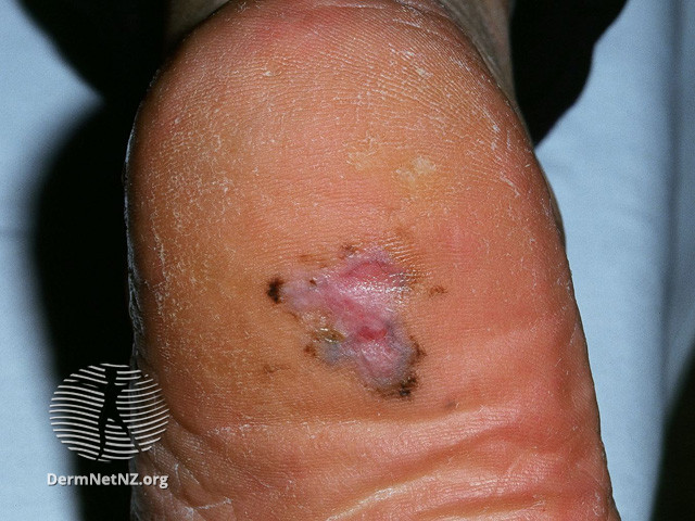 File:Acral lentiginous melanoma (DermNet NZ melanoma-alm2).jpg