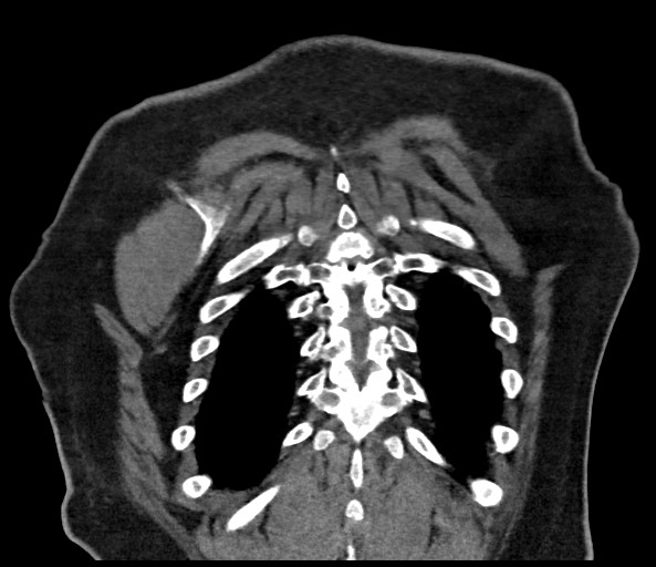 Acromioclavicular joint cyst (Radiopaedia 58455-65610 Coronal C+ arterial phase 124).jpg