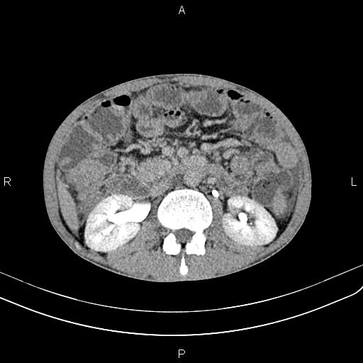 Active crohn disease (Radiopaedia 87133-103397 Axial C+ delayed 23).jpg