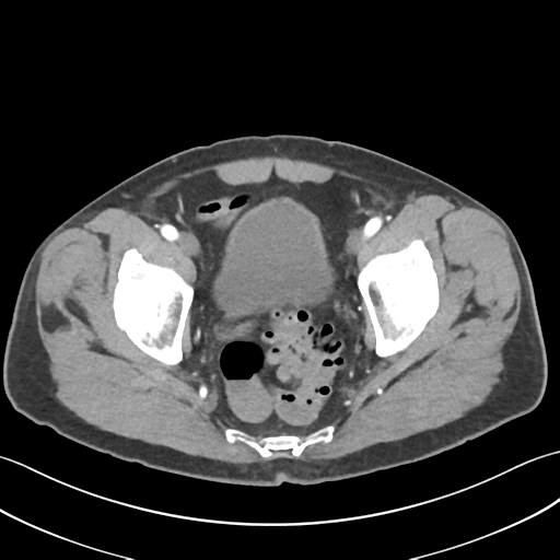 File:Active diverticular hemorrhage (Radiopaedia 39415-41725 Axial C+ arterial phase 62).png