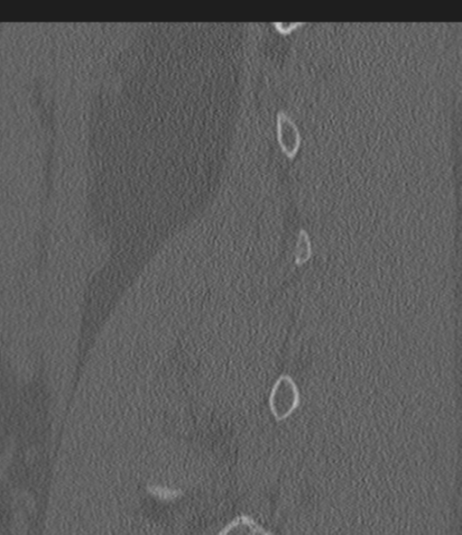 Acute L1 burst compression fracture (Radiopaedia 34430-35755 Sagittal bone window 52).png