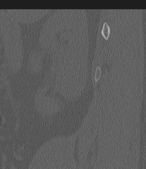 Acute L1 burst compression fracture (Radiopaedia 34430-35755 Sagittal bone window 69).png
