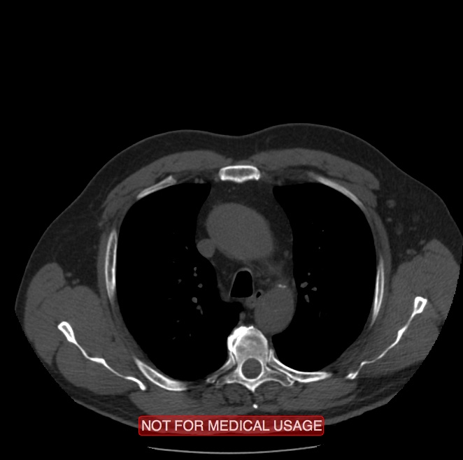 Acute aortic dissection - Stanford type A (Radiopaedia 40661-43285 Axial non-contrast 9).jpg