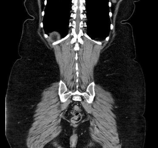 Acute appendicitis, heterotaxy syndrome (Radiopaedia 66884-76202 Coronal C+ portal venous phase 104).jpg