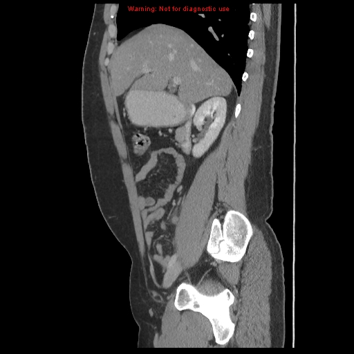 File:Acute appendicitis (Radiopaedia 10498-10973 Sagittal C+ portal venous phase 11).jpg