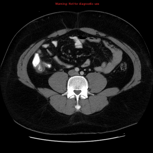 File:Acute appendicitis (Radiopaedia 12326-12607 Axial C+ portal venous phase 11).jpg