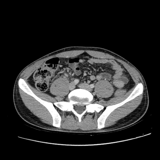 Acute appendicitis (Radiopaedia 27049-27227 Axial C+ portal venous phase 50).jpg