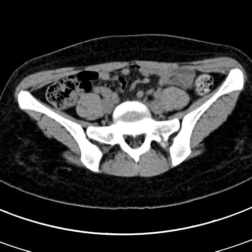 Acute appendicitis (Radiopaedia 30261-30888 Axial non-contrast 68).jpg