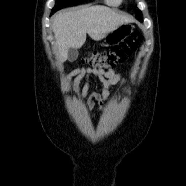 Acute appendicitis (Radiopaedia 38255-40270 Coronal C+ portal venous phase 18).jpg