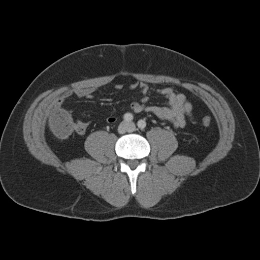 Acute appendicitis (Radiopaedia 48511-53463 Axial C+ portal venous phase 63).jpg