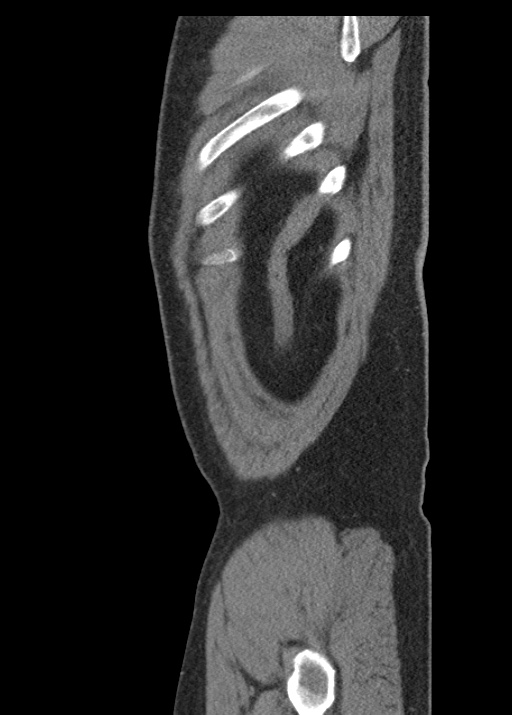 Acute appendicitis (Radiopaedia 48511-53463 Sagittal C+ portal venous phase 120).jpg