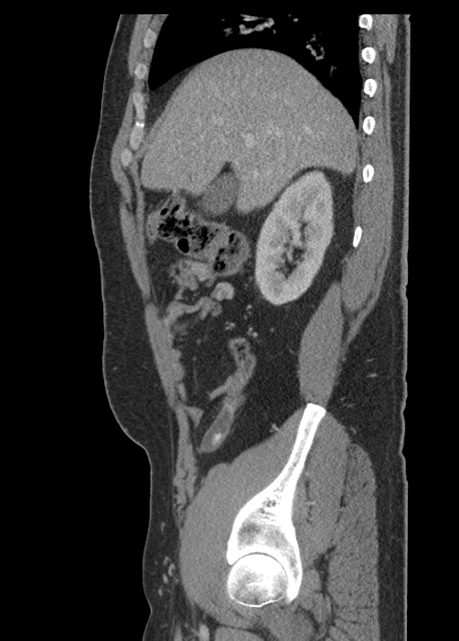 Acute appendicitis (Radiopaedia 48511-53463 Sagittal C+ portal venous phase 45).jpg