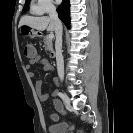 Acute appendicitis (Radiopaedia 66513-75790 Sagittal C+ portal venous phase 71).jpg